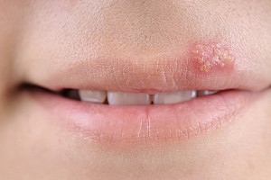 Herpes: Lebenslange Virusinfektion