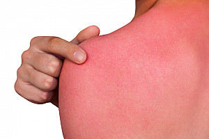 Sonnenbrand Regeneration nötig